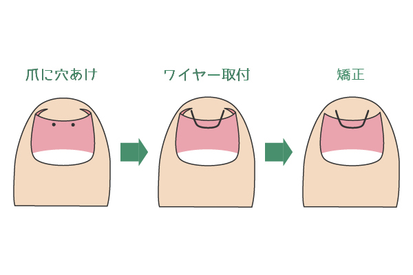 マチワイヤー法による爪矯正について