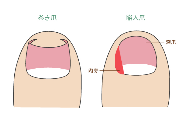 巻き爪と陥入爪の違いについて