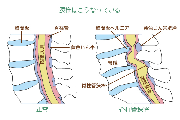 腰部脊柱管狭窄症(ようぶせきちゅうかんきょうさくしょう)